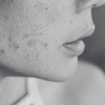 Black and white image of a young woman face, showing acne all over her skin. For this we have HerbsTonic Anti Acne Natural Face Pack for best skin.