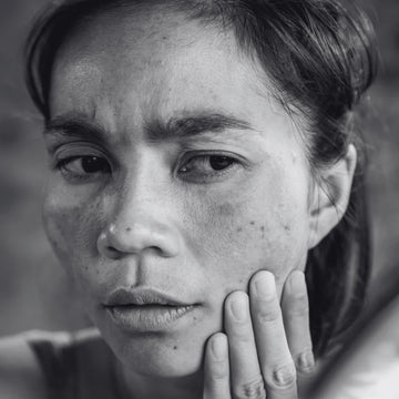 A black and white image of a lady, moving her hand on her face, because she got sun burn. For this we got Herbstonic Charcoal Soap.